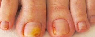 The main symptoms and photos of onychomycosis