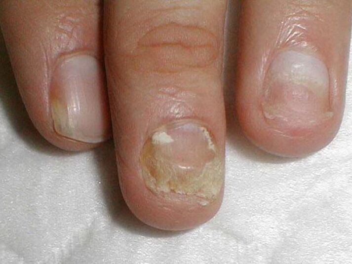 Candida nail fungus treatment