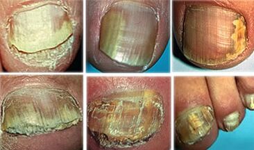 Onychomycosis in advanced stage