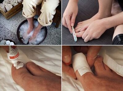 Steaming the feet and applying urea cream to the nails affected by the fungus