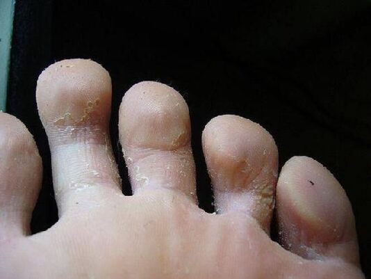 what a fungus on the feet looks like