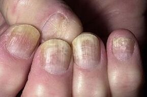 change on the nail with a fungal infection