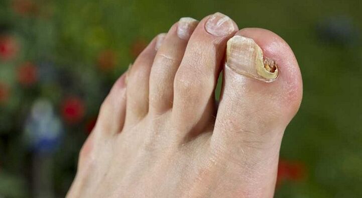 damage to the nail plate by fungi on the feet