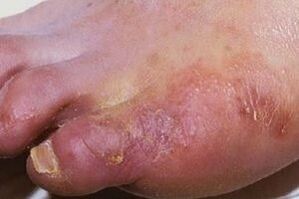 manifestations of fungal infection on the skin of the feet