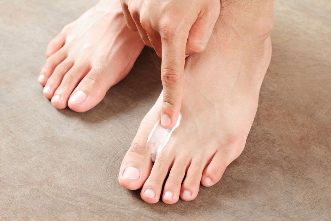 treating fungus on the feet with ointment