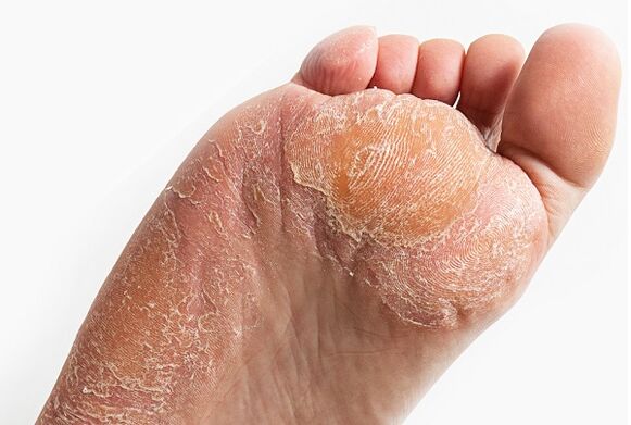 peeling of the skin when infected with the fungus