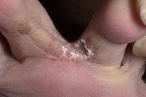 fungus on the skin between the toes