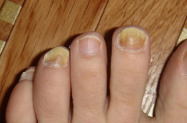 symptoms of fungus on the nails and skin of the feet