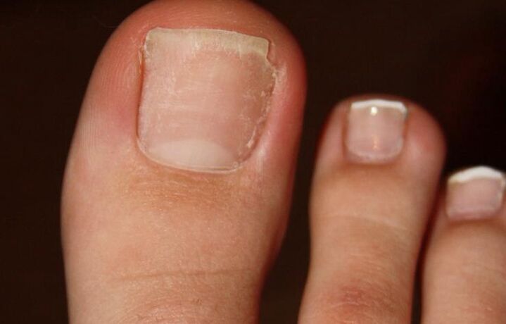 symptoms of fungus on the toes