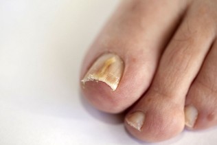 fungus of the toenails
