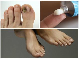 fungus of toenails treatment